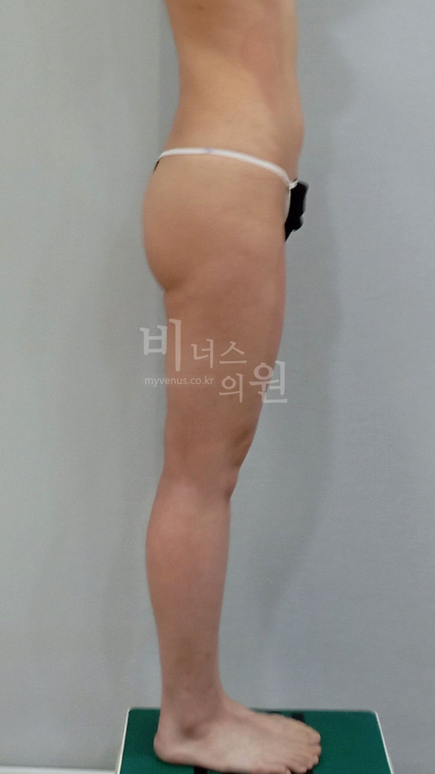 엉덩이 지방흡입과 자가지방이식을 병행한 사례의 수술 전 측면 사진