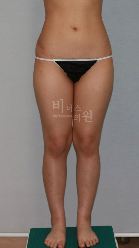 허벅지지방흡입 수술 전 정면 사진