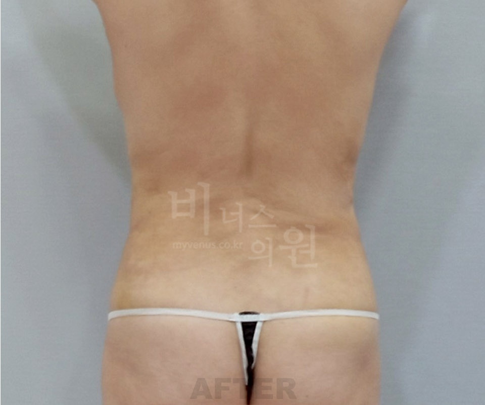 복부지방흡입 수술 후 후면 사진