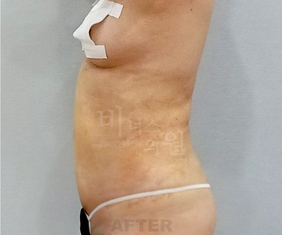 복부지방흡입 수술 후 측면 사진