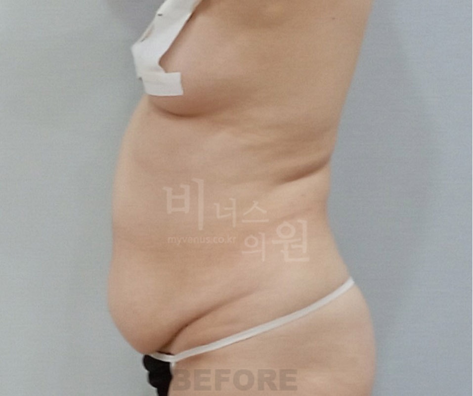 복부지방흡입 수술 전 측면 사진