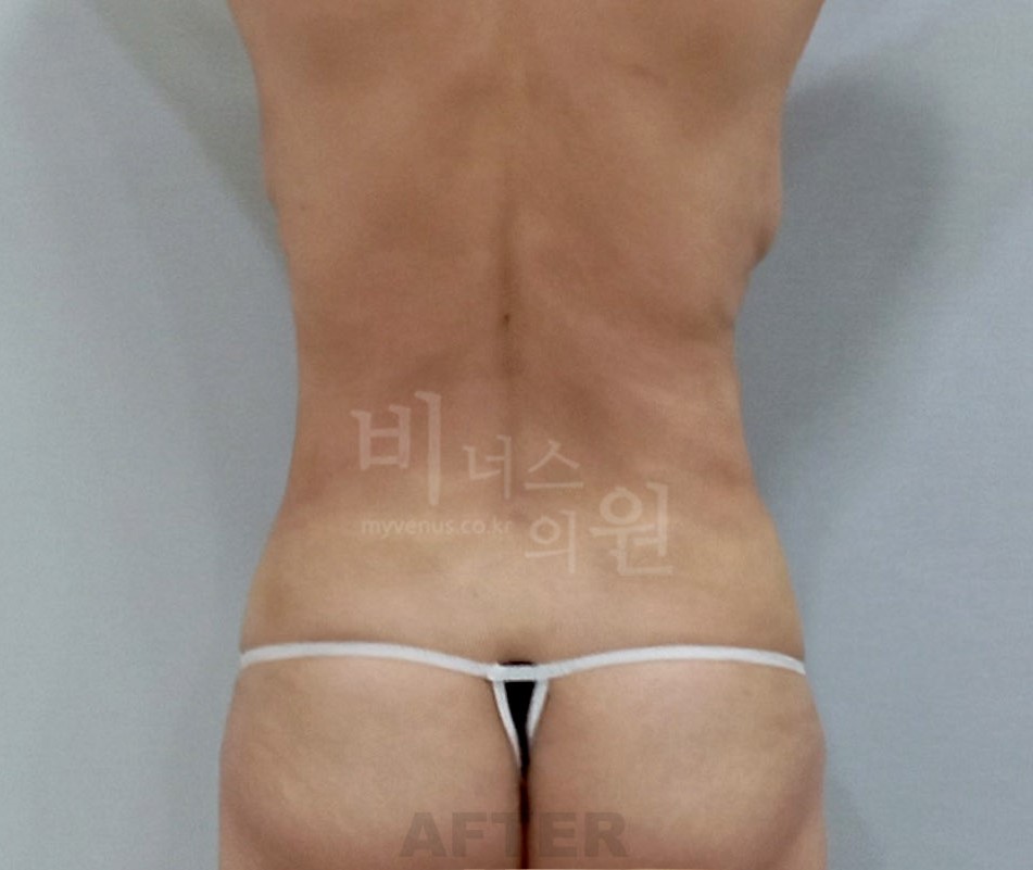 복부 지방흡입 후면 수술 후 사진
