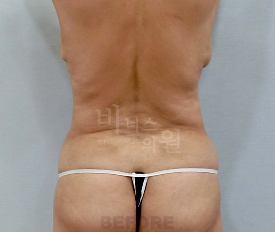 복부 지방흡입 후면 수술 전 사진