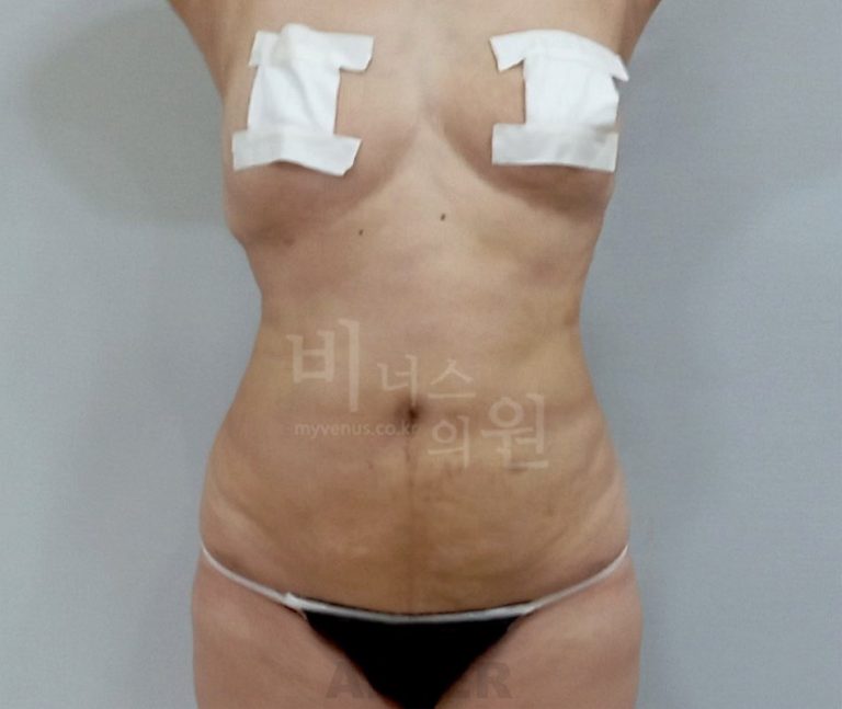 복부 지방흡입 수술 후 정면 사진