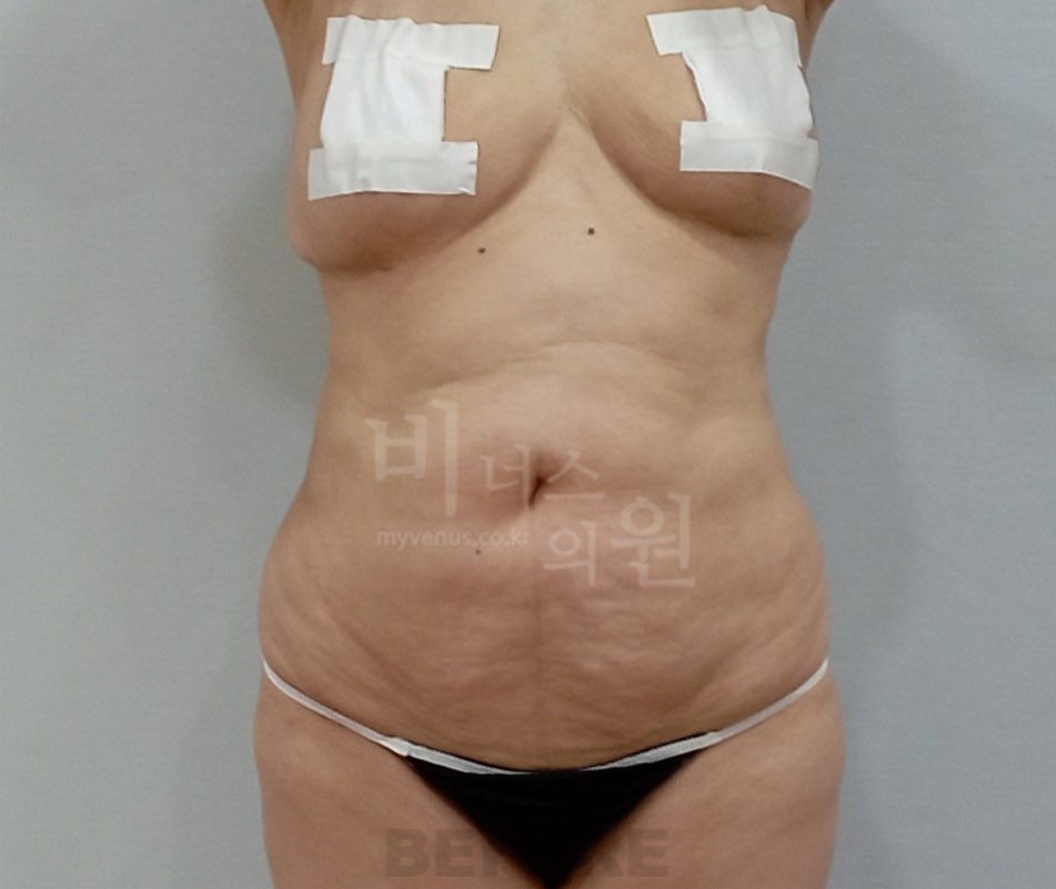 복부 지방흡입 정면 수술 전 사진