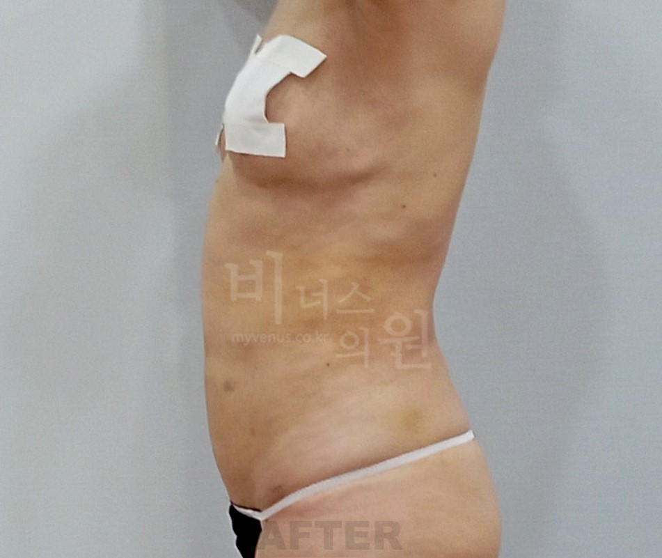 복부 지방흡입 측면 수술 후 사진