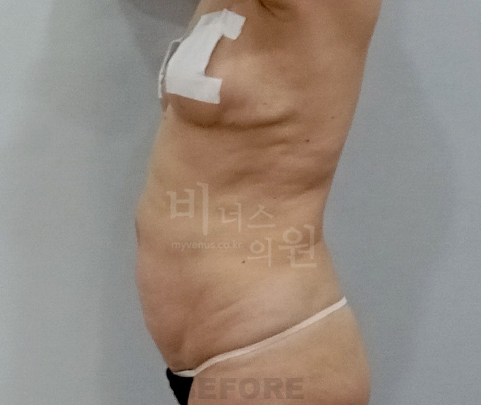 복부 지방흡입 측면 수술 전 사진