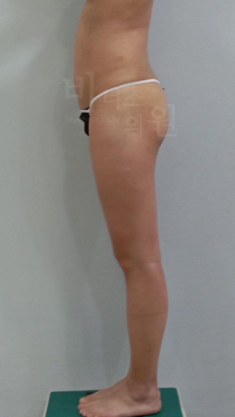 엉덩이축소 지방흡입 회복기 생활 관리 — 잠자리·샤워부터 오래 유지하는 습관까지