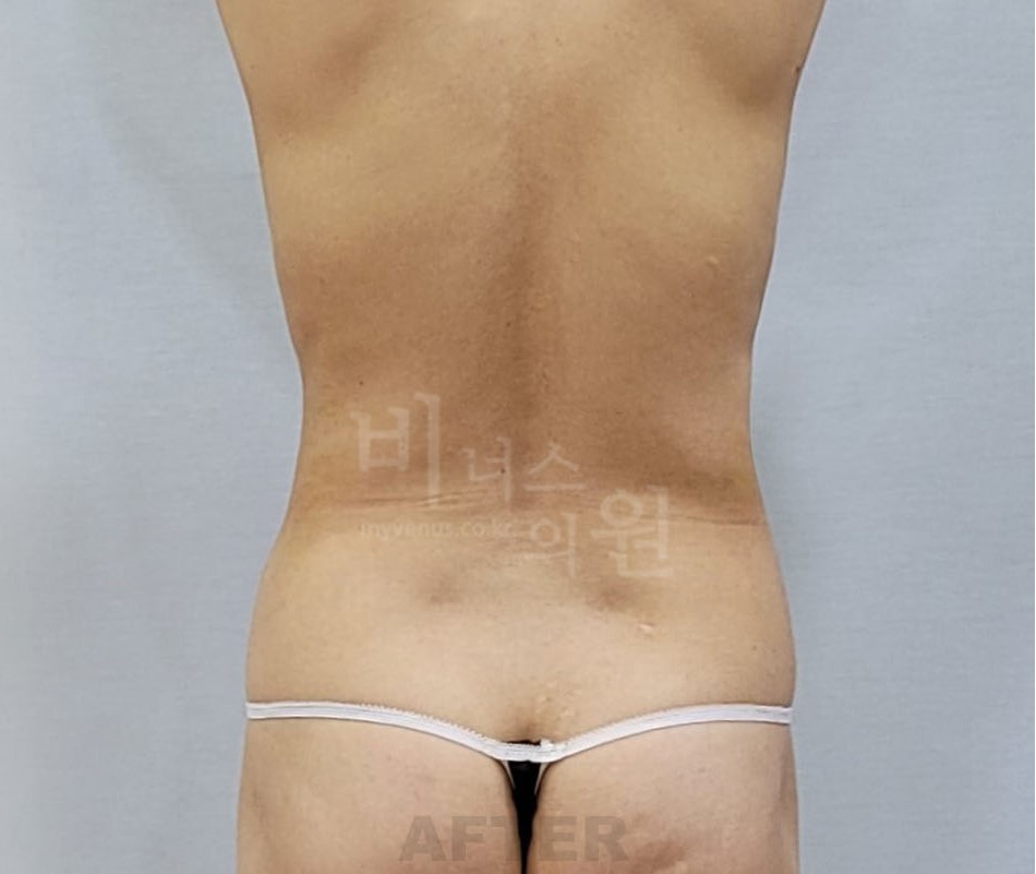 복부 지방흡입 수술 후 후면 사진