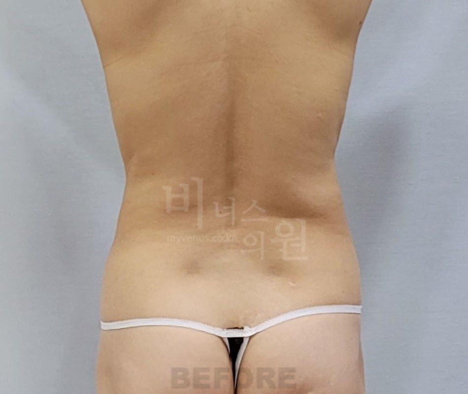 복부 지방흡입 수술 전 후면 사진