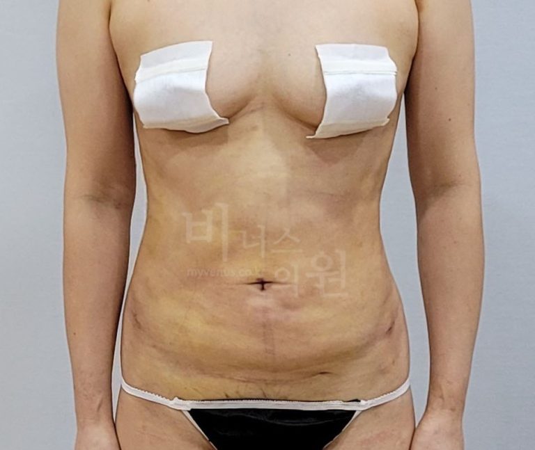 복부 지방흡입 수술 후 정면 사진