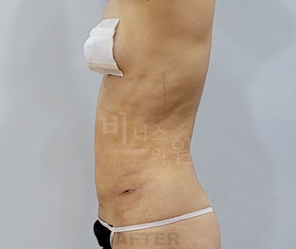 복부 지방흡입 수술 후 측면 사진
