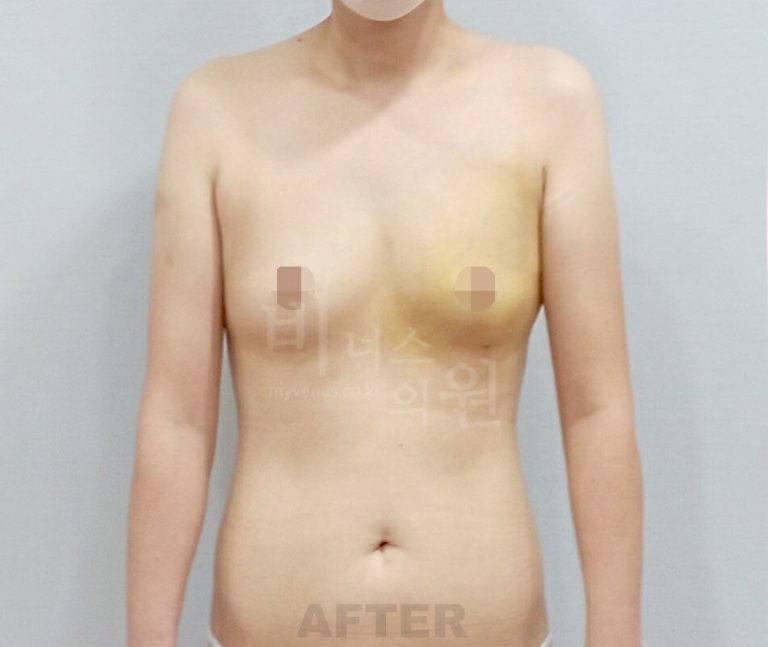 유방처짐, 상담실에서 가장 많이 듣는 이야기부터 표층 지방흡입 회복까지