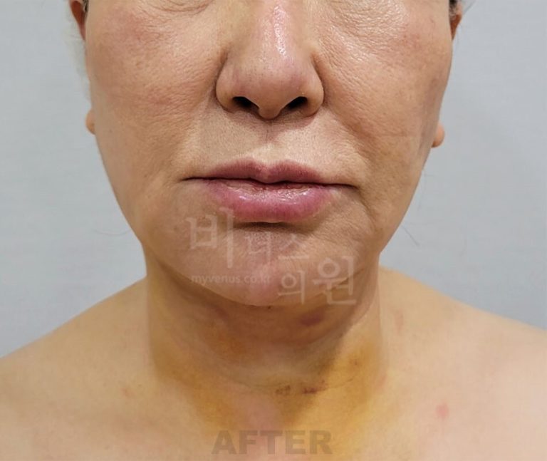 턱지방흡입 수술 후 1주일 정면 비너스의원