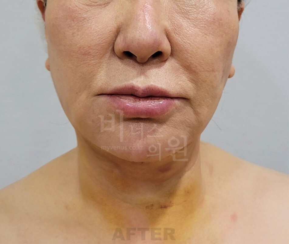 턱지방흡입 수술 후 1주일 정면 비너스의원