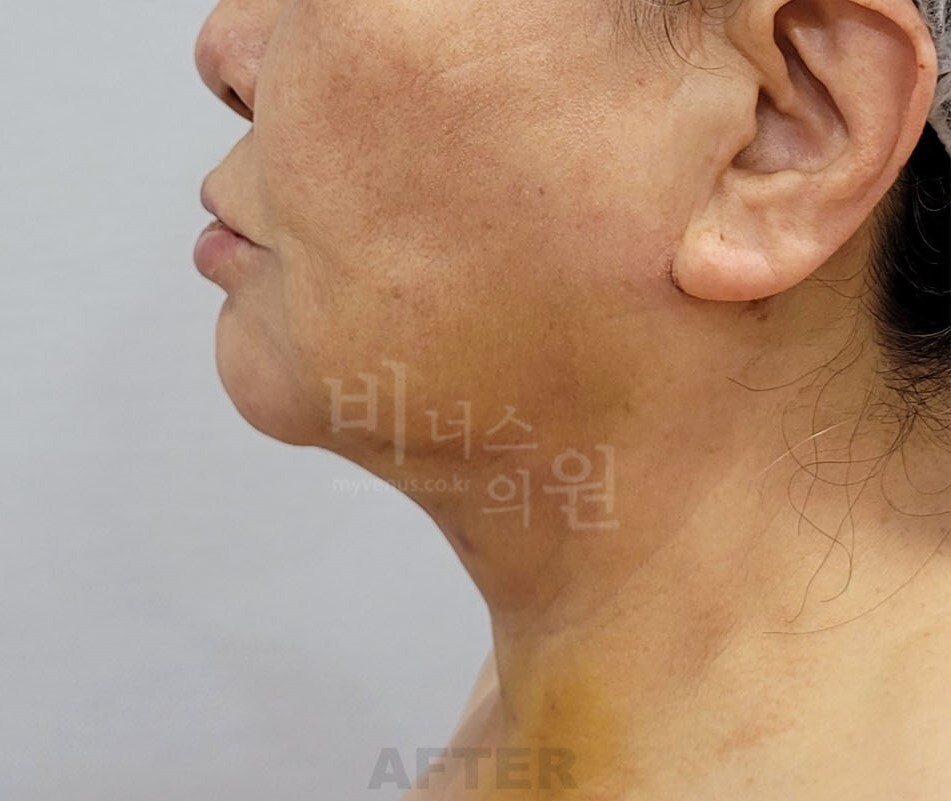 턱지방흡입 수술 후 1주일 우측면 비너스의원