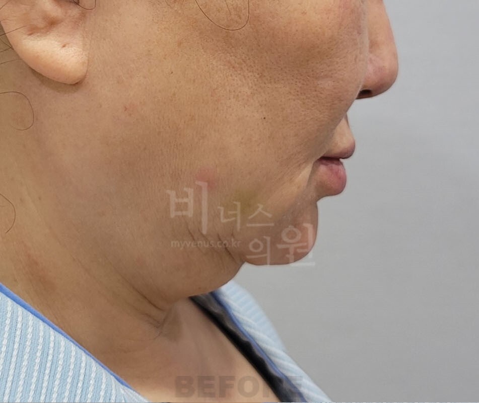 턱지방흡입 수술 전 좌측면 비너스의원