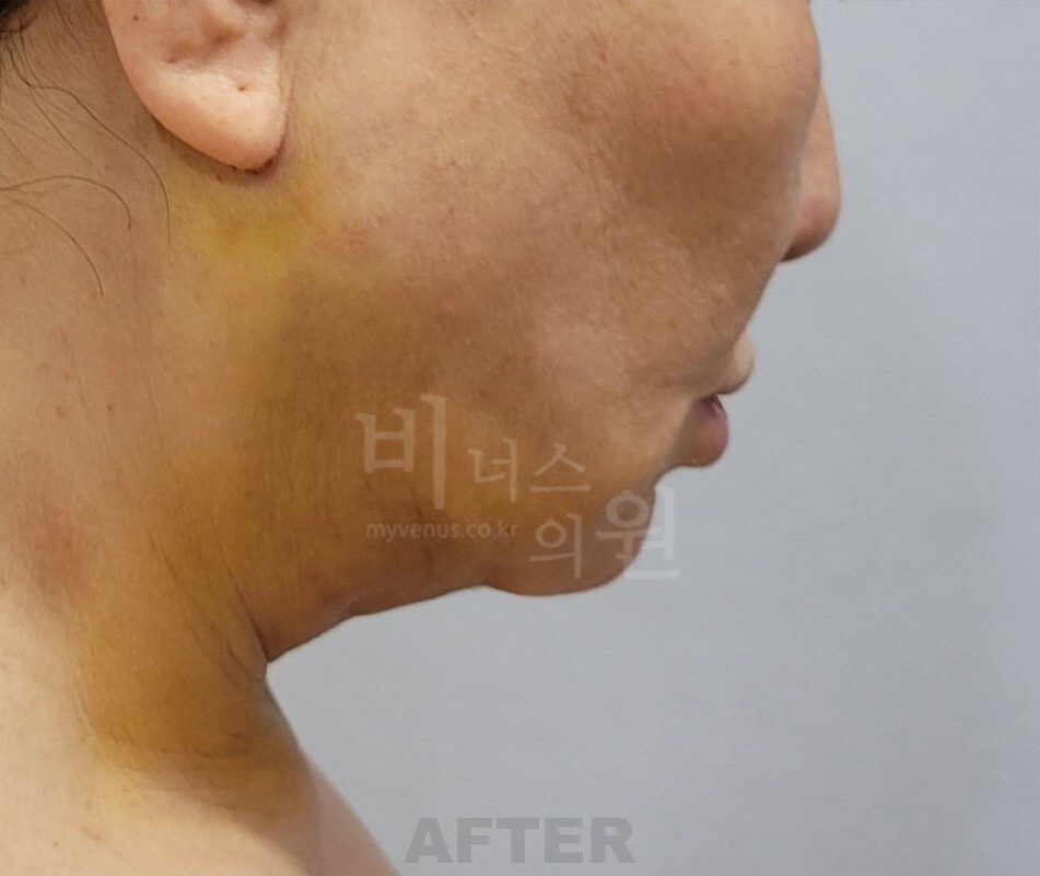 턱지방흡입 수술 후 1주일 좌측면 비너스의원