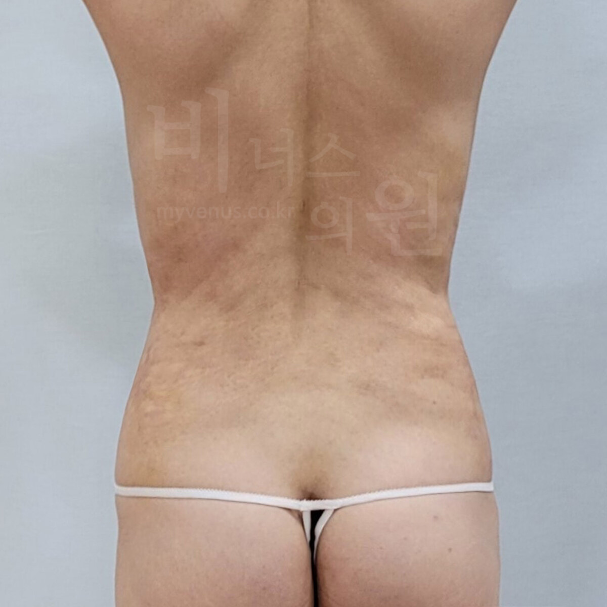 복부 지방흡입 수술 후 후면 사진 - 정리된 뒷등과 허리 라인