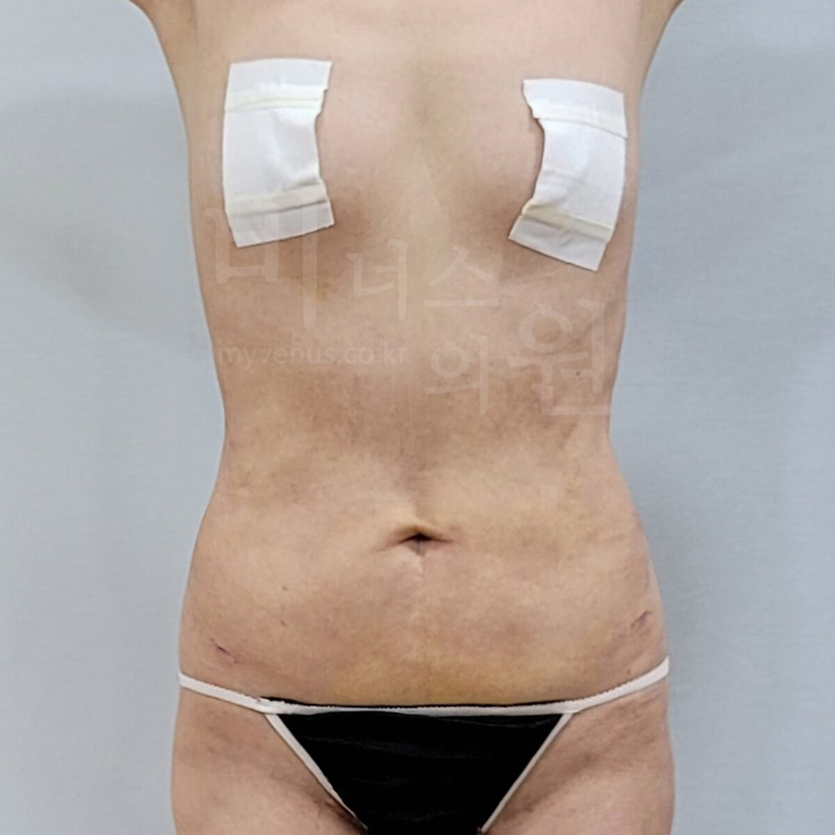 복부 지방흡입 수술 후 정면 사진 - 허리 라인이 드러난 모습