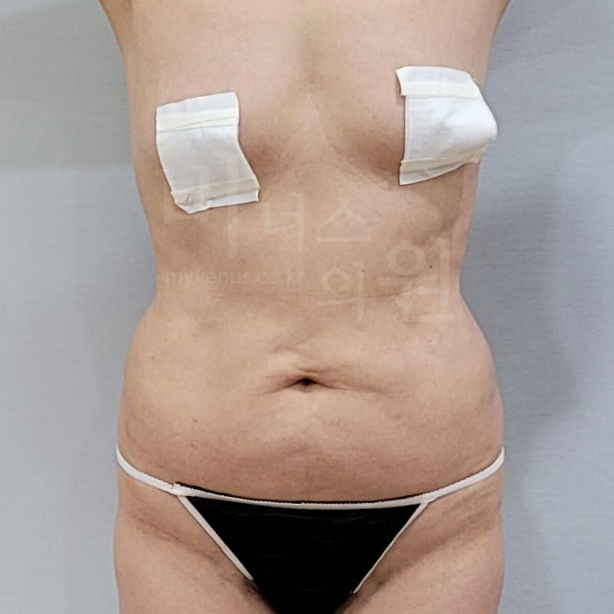복부 지방흡입 수술 전 정면 사진 - 상복부와 하복부 라인