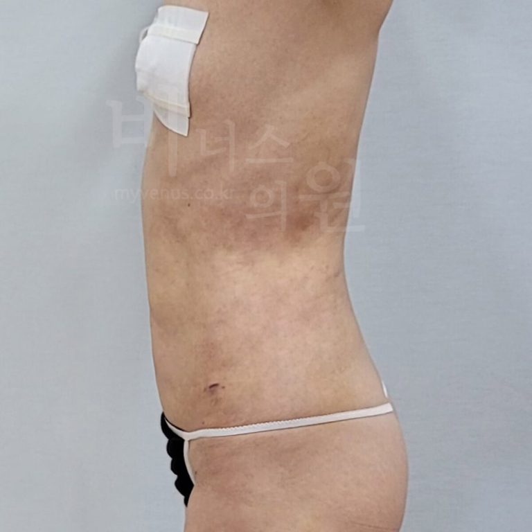 복부 지방흡입 수술 후 우측면 사진