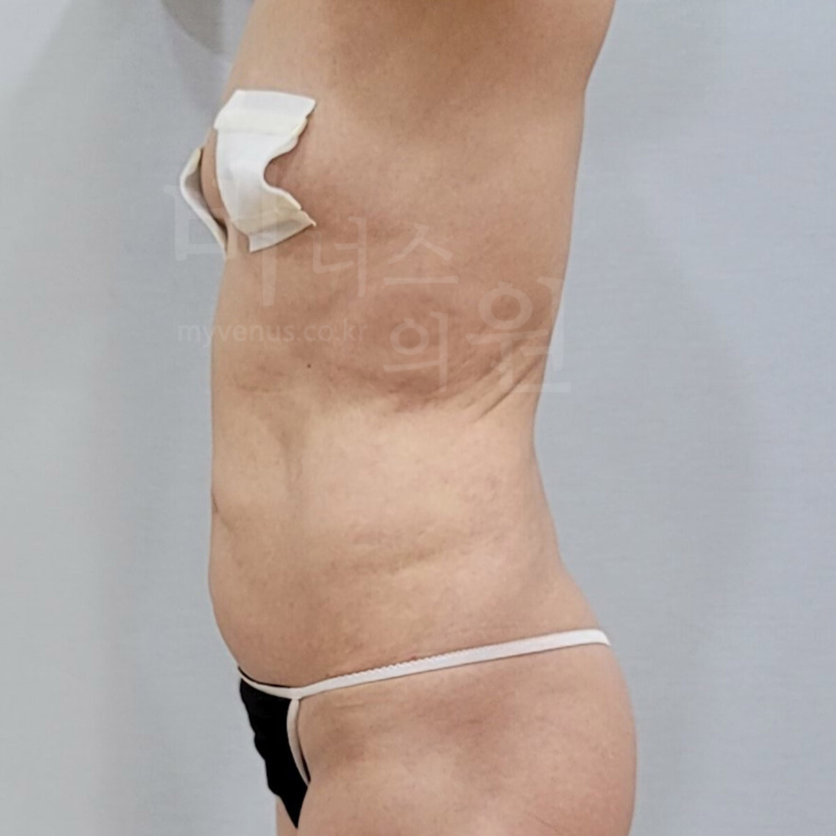 복부 지방흡입 수술 전 우측면 사진 - 하복부와 옆구리 라인