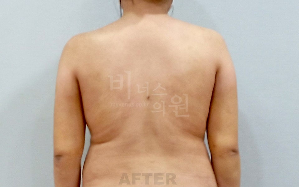 팔뚝 지방흡입 사례 후면(팔을 내린 자세) 수술 후