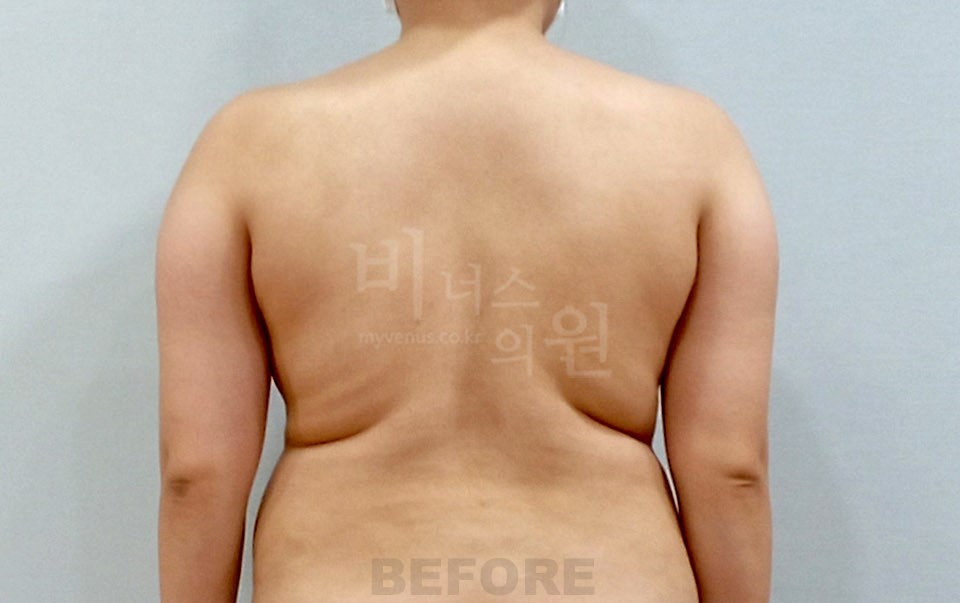 팔뚝 지방흡입 사례 후면(팔을 내린 자세) 수술 전