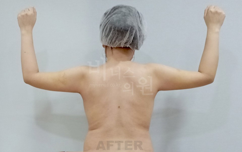 팔뚝 지방흡입 사례 후면(팔을 든 자세) 수술 후