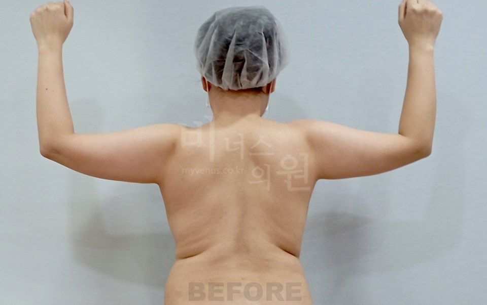 팔뚝 지방흡입 사례 후면(팔을 든 자세) 수술 전
