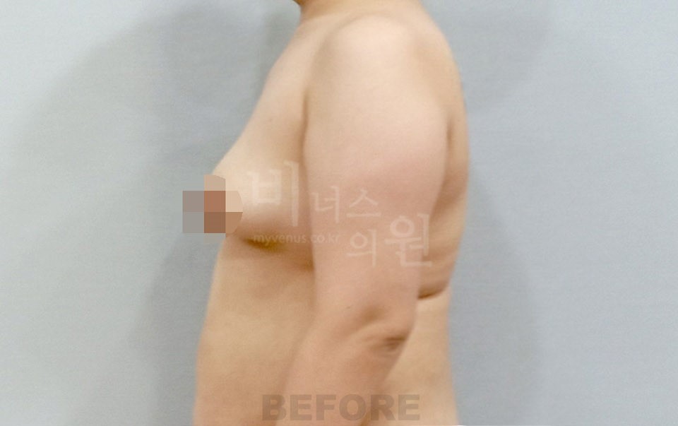 팔뚝 지방흡입 사례 측면(팔을 내린 자세) 수술 전
