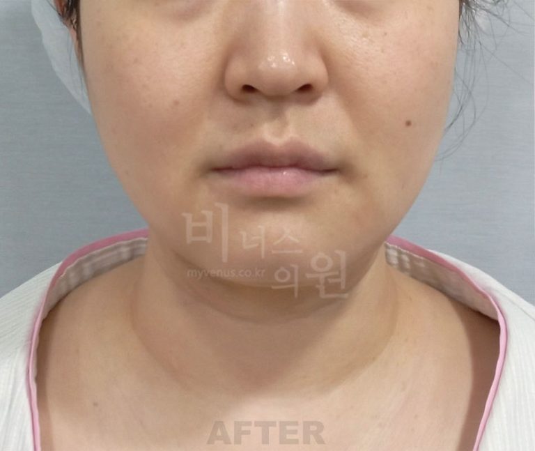 얼굴 하부·턱선 정면 수술 후 사진 — 부천 비너스의원