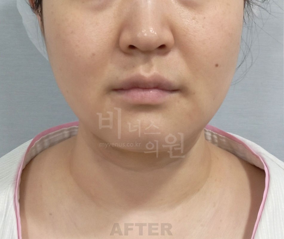 얼굴 하부·턱선 정면 수술 후 사진 — 부천 비너스의원