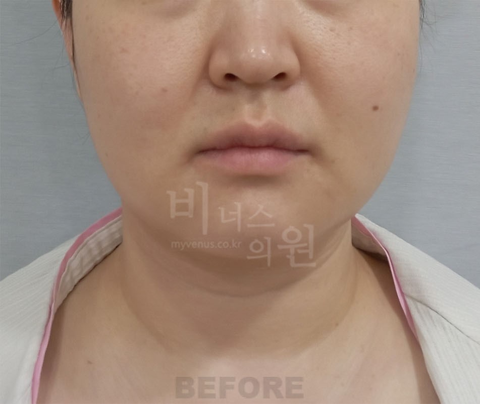 얼굴 하부·턱선 정면 수술 전 사진 — 부천 비너스의원