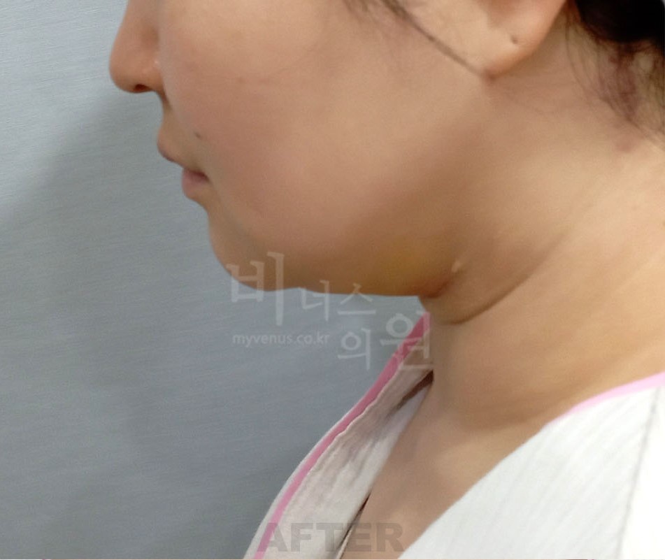 얼굴 하부·턱선 측면 수술 후 사진 — 부천 비너스의원