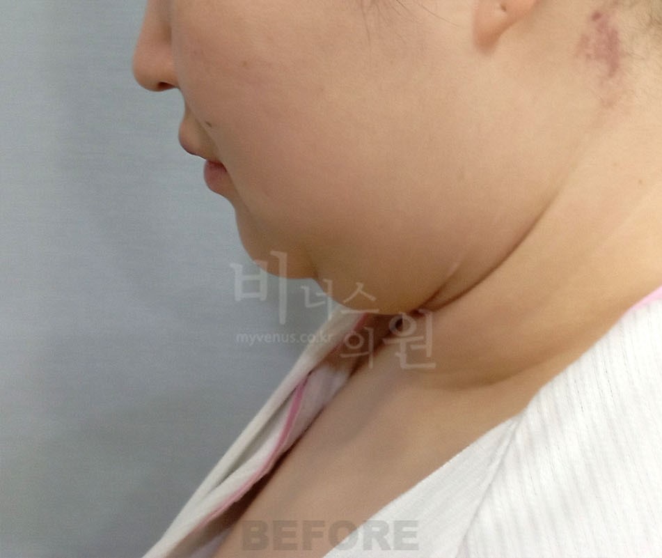얼굴 하부·턱선 측면 수술 전 사진 — 부천 비너스의원