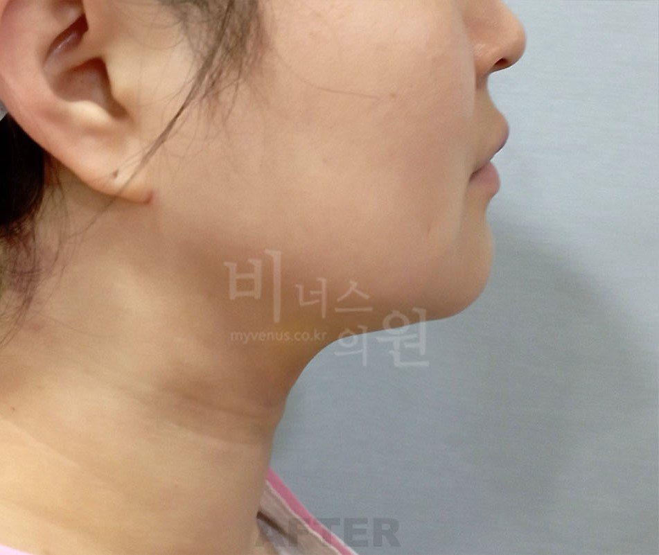 얼굴 하부·턱선 반대쪽 측면 수술 후 사진 — 부천 비너스의원