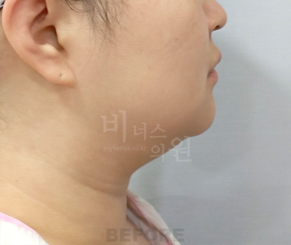 얼굴 하부·턱선 반대쪽 측면 수술 전 사진 — 부천 비너스의원