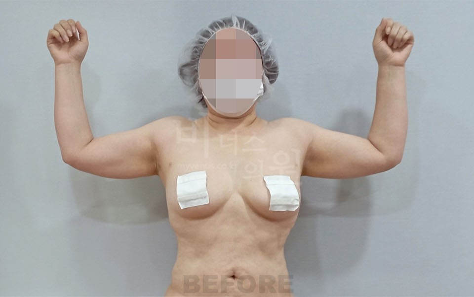 팔뚝지방흡입 수술 전 정면, 팔꿈치를 굽혀 양팔을 든 자세