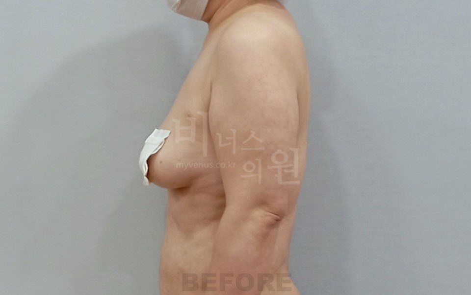 팔뚝지방흡입 수술 전 측면
