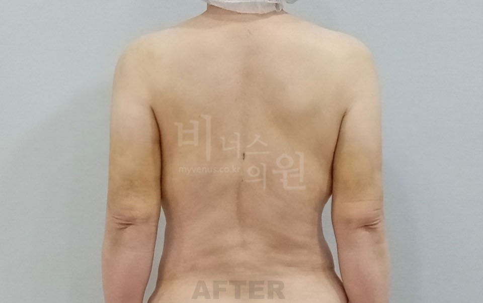 팔뚝지방흡입 수술 후 후면, 팔을 내린 자세