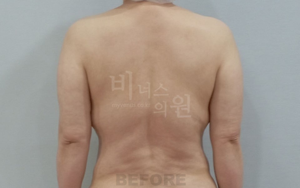 팔뚝지방흡입 수술 전 후면, 팔을 내린 자세