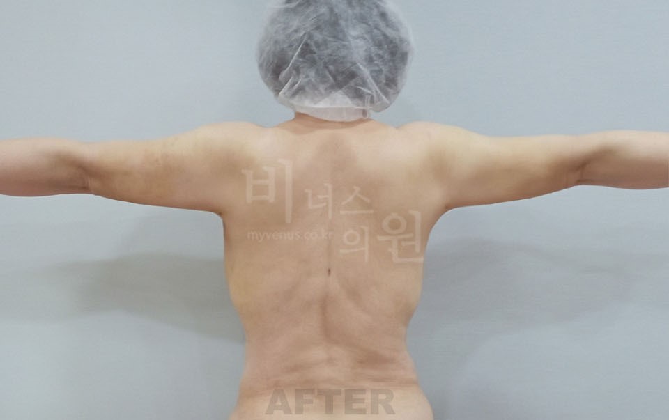 팔뚝지방흡입 수술 후 후면, 팔을 수평으로 든 자세