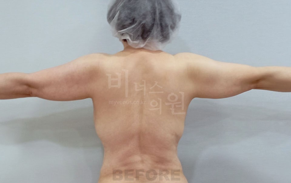 팔뚝지방흡입 수술 전 후면, 팔을 수평으로 든 자세