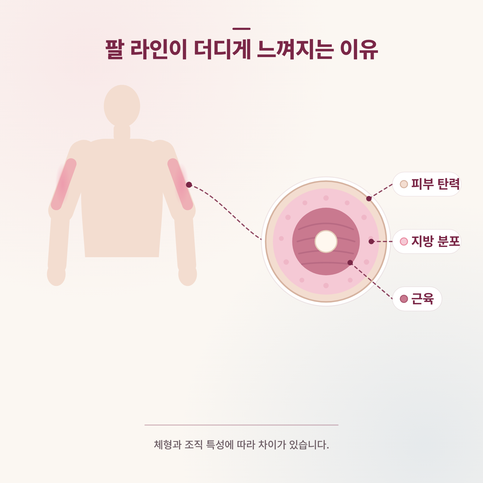 팔 라인이 더디게 느껴지는 이유를 설명하는 의학 인포그래픽
