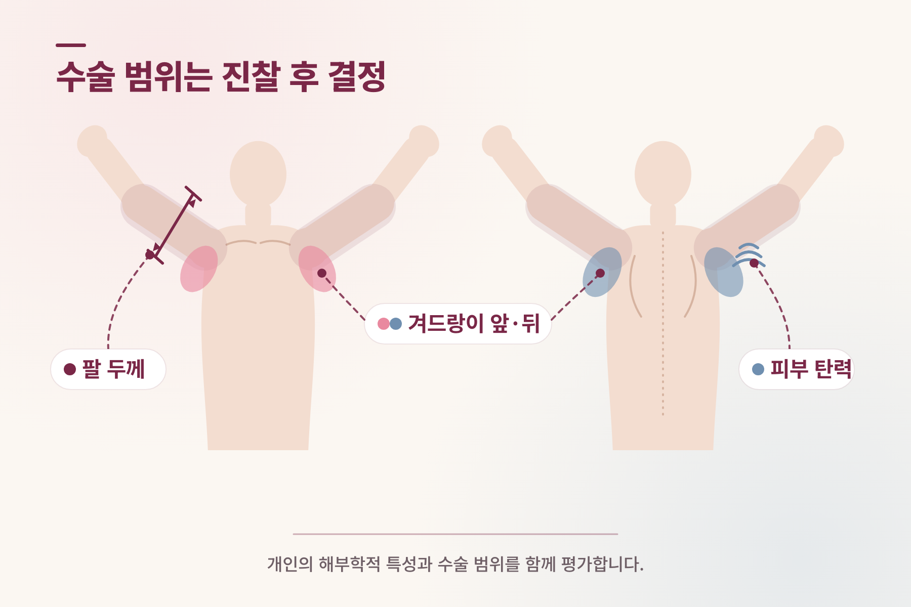 팔 지방흡입 수술 범위 평가 요소를 보여주는 의학 인포그래픽