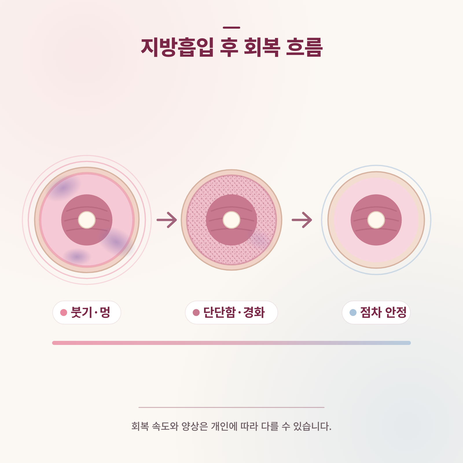 팔 지방흡입 후 회복 흐름을 보여주는 의학 인포그래픽