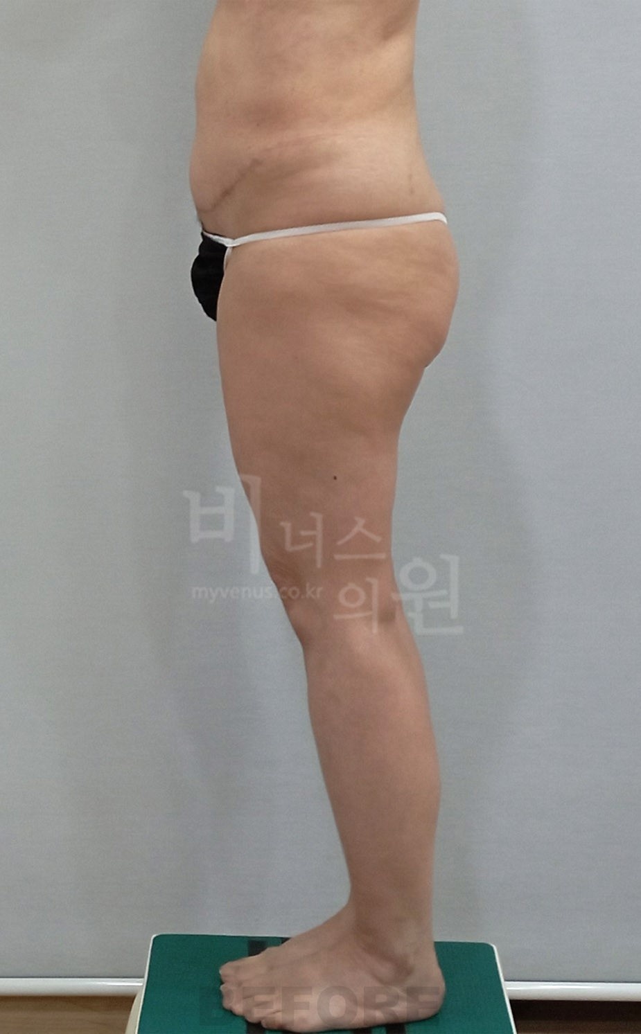 허벅지지방흡입 수술 전 측면 사진, 비너스의원