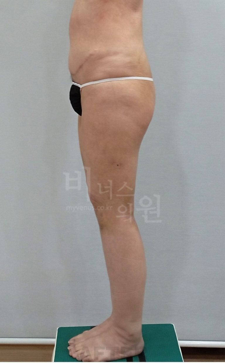 허벅지지방흡입 후 일상 복귀 루틴 — 압박복·경화관리부터 운동 재개까지 시기별로 정리해봤습니다